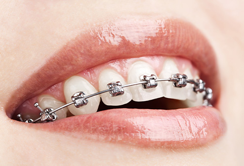 Braces in Weatherford, TX