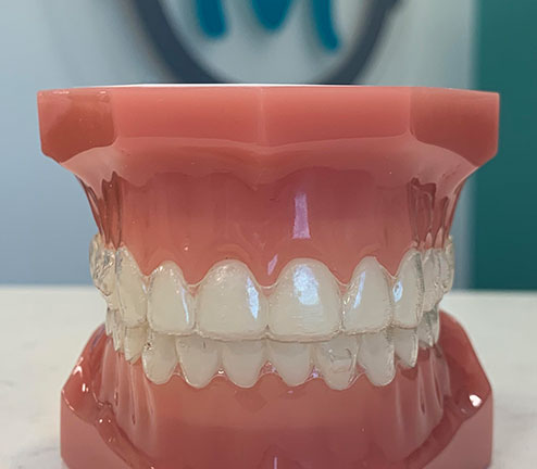 Photo of braces impression