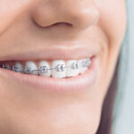 Closeup of the mouth of a celebrity who had braces as an adult