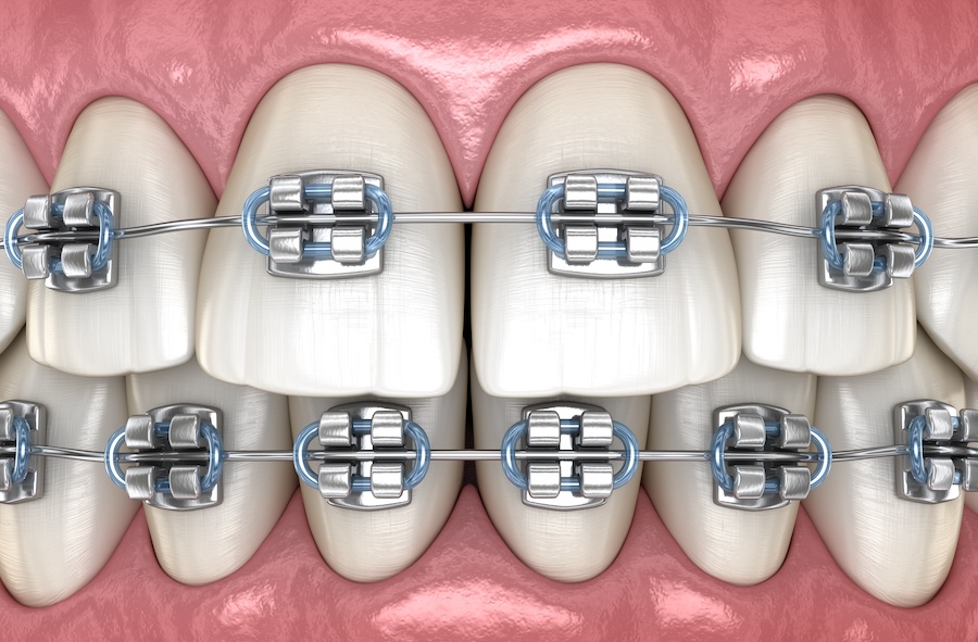 broken brackets, orthodontic care, braces care, Meason Orthodontics, Weatherford TX, orthodontic tips, protect braces, avoid broken brackets, weatherford orthodontist