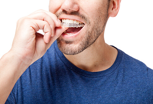man putting in a clear aligner